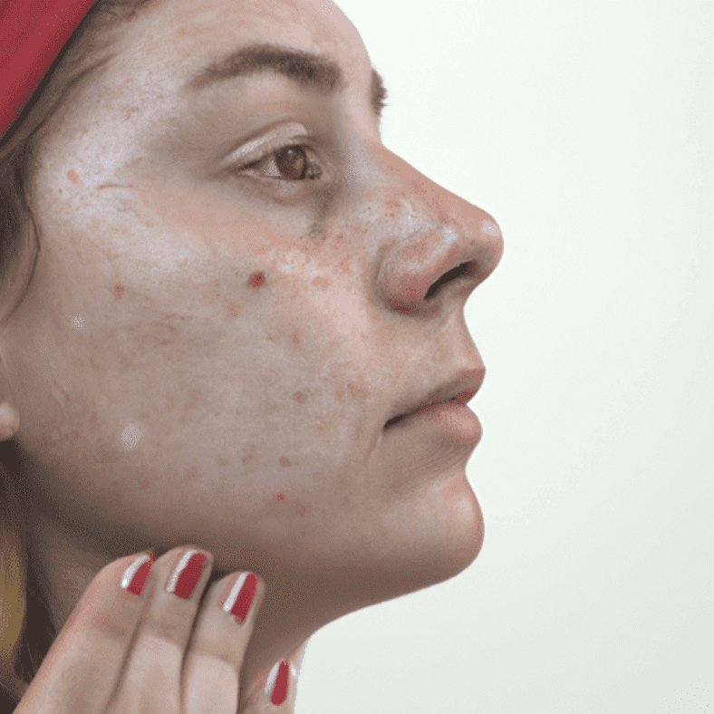 The Link Between Acne and Hormones