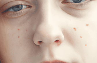 Effective Acne Treatments for Teenagers
