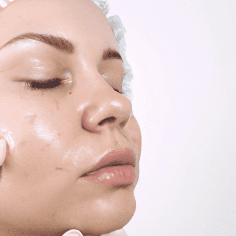 The Benefits of Starting Botox Sooner