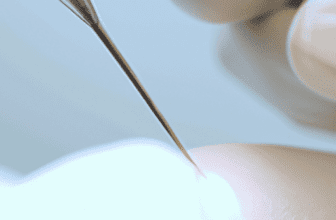 Advantages of Mohs Surgery in Skin Cancer Removal