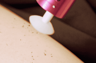 What to anticipate with laser hair removal