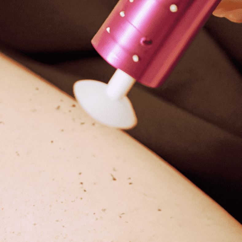 What to anticipate with laser hair removal