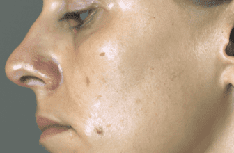 Understanding the causes of acne
