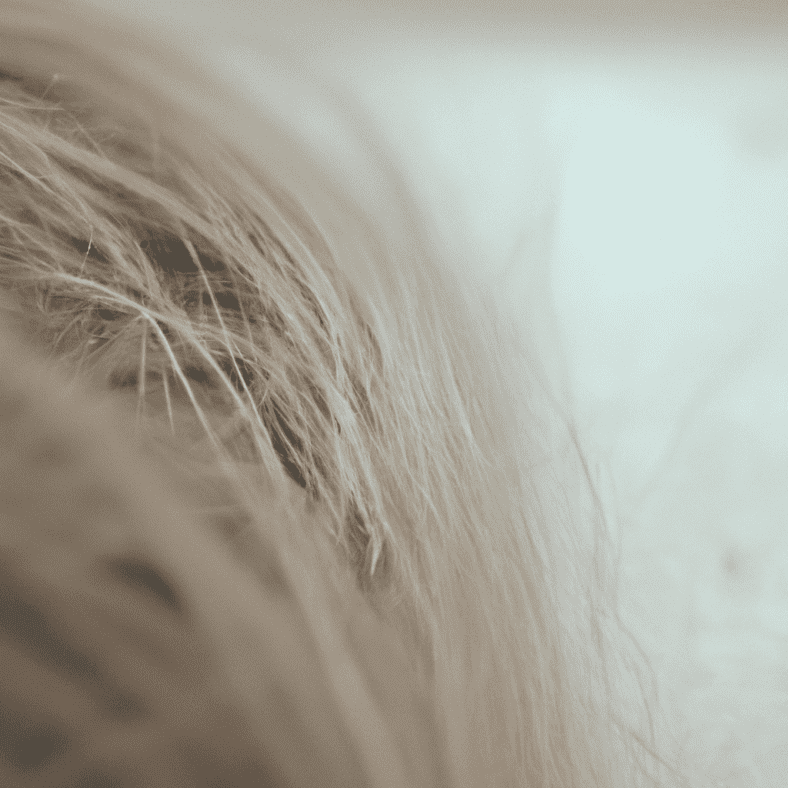 Understanding Female Pattern Hair Loss