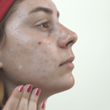 The Link Between Acne and Hormones